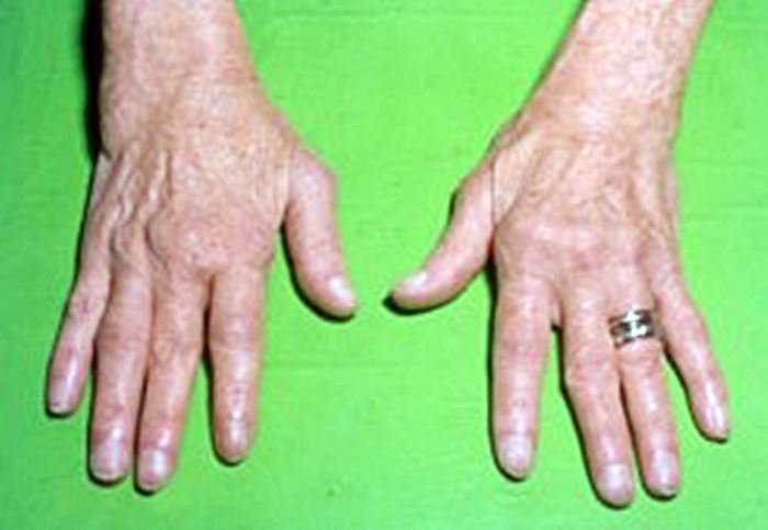 hogyan lehet megállítani az ízületi gyulladást ízületi gyulladás az ujj ízületein